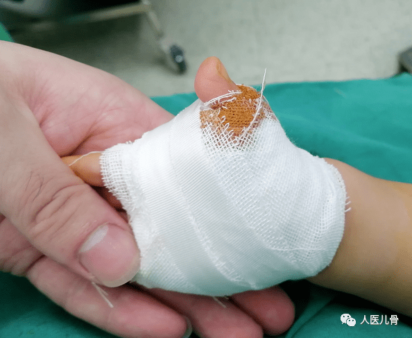 最后,分享今日手术案例儿童扳机指手术可以说是小儿骨科最简单的手术