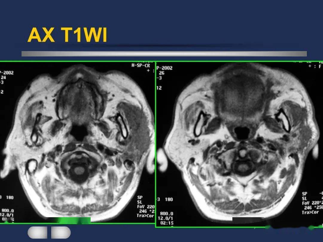 腮腺颈部疾病影像诊断