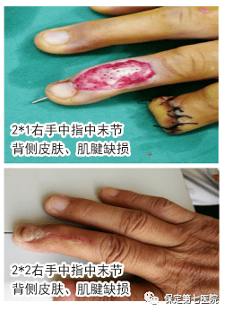 【科普】人工真皮支架
