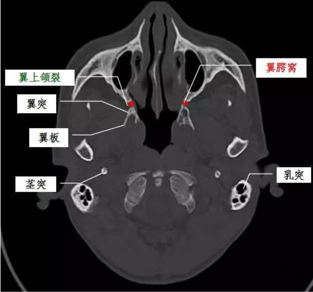 上颌骨解剖图ct横断图片