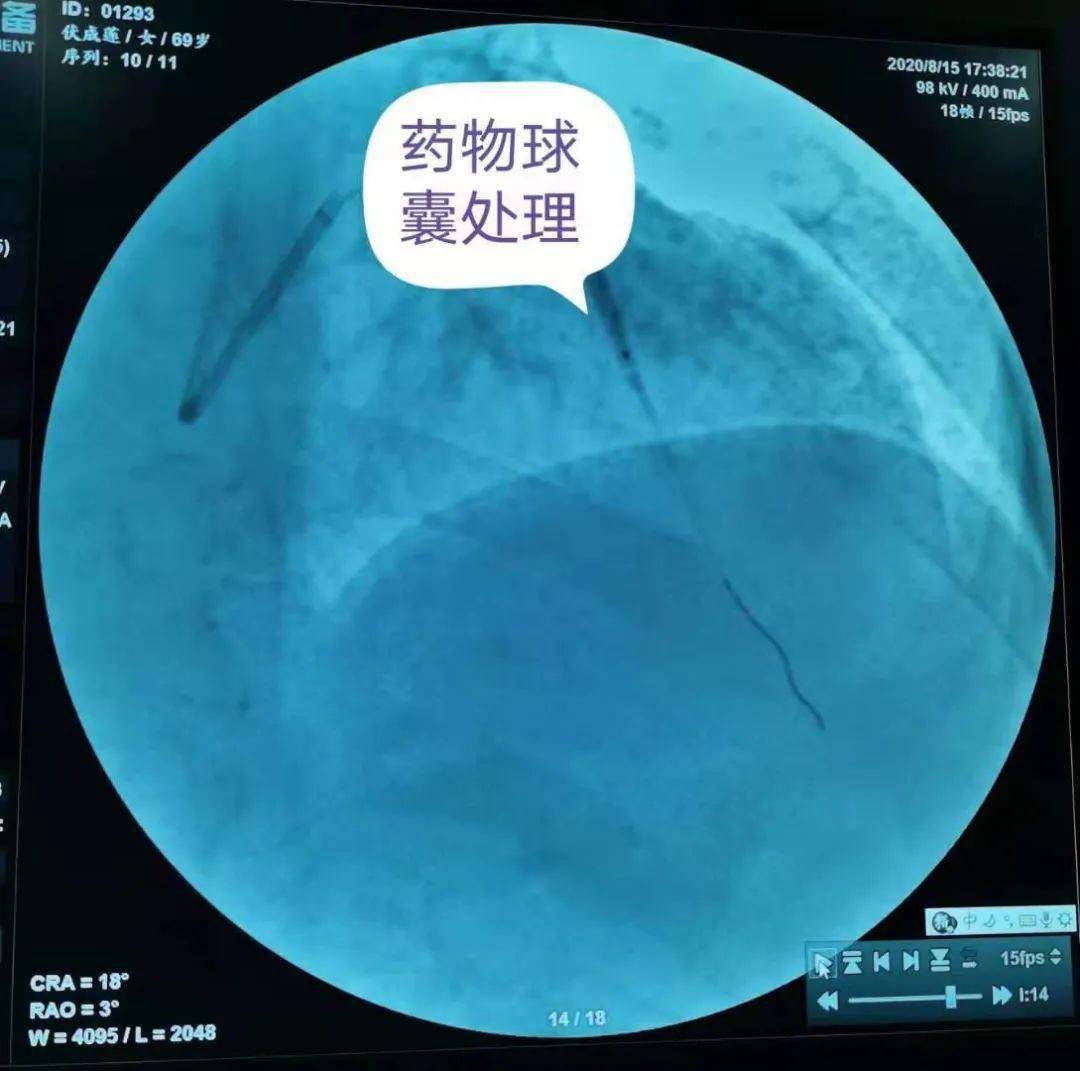 诸城中医医院:成功开展药物涂层球囊治疗心脏支架内再狭窄