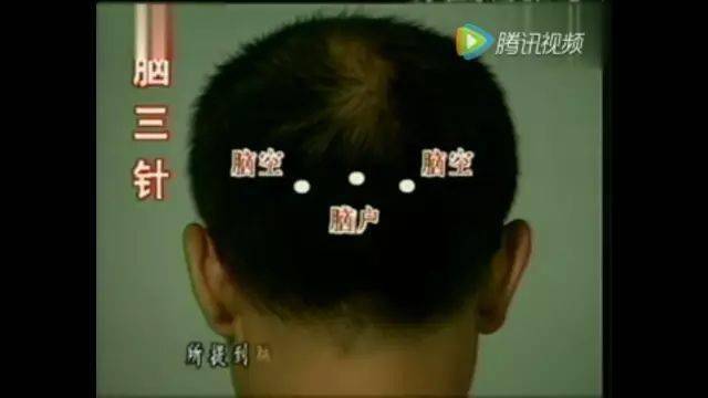 【干货】靳三针30组穴位(图文并茂)_治疗