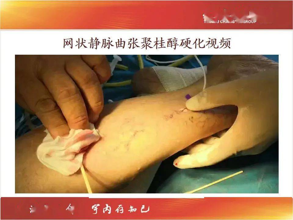 讲座分享 | 毛细血管扩张症及网状静脉曲张硬化治疗(附精彩讲座视频)