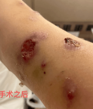 感染这种细菌,伤口久不愈合专家预估治愈至少需要一年半但受的这些皮