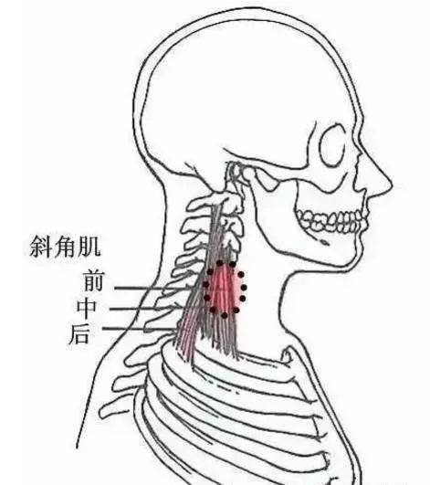 7項伸肌群和項筋膜壓痛點在枕骨和頸椎棘突附著處和原發性損害的疼痛