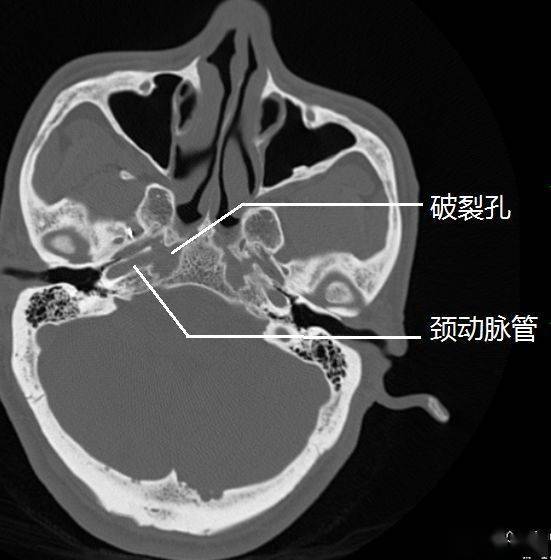 高清图谱颈内动脉走形图谱2岩段和破裂孔段