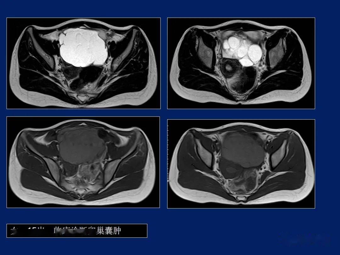 妇产科常见疾病mri表现
