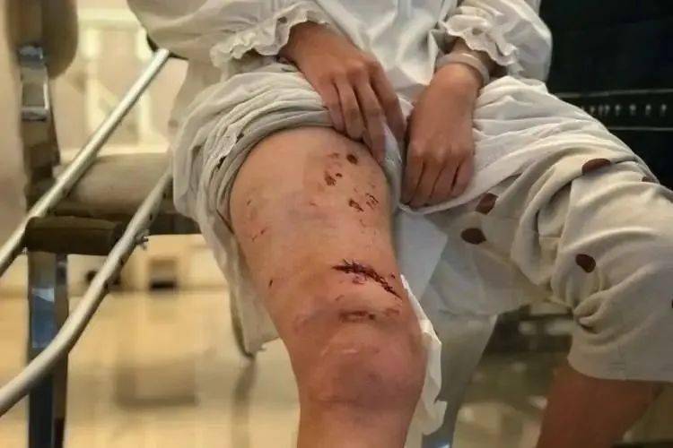 又是烈犬伤人上海一女子在小区内被烈性犬咬伤大腿更可气的是这只狗不