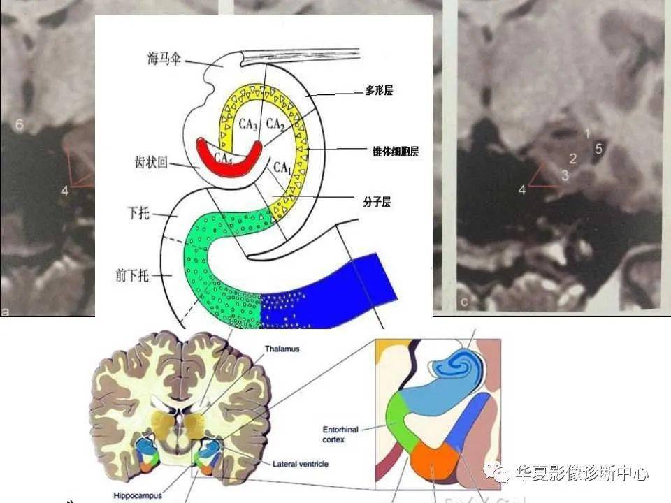 海馬解剖結構與海馬硬化的mri診斷