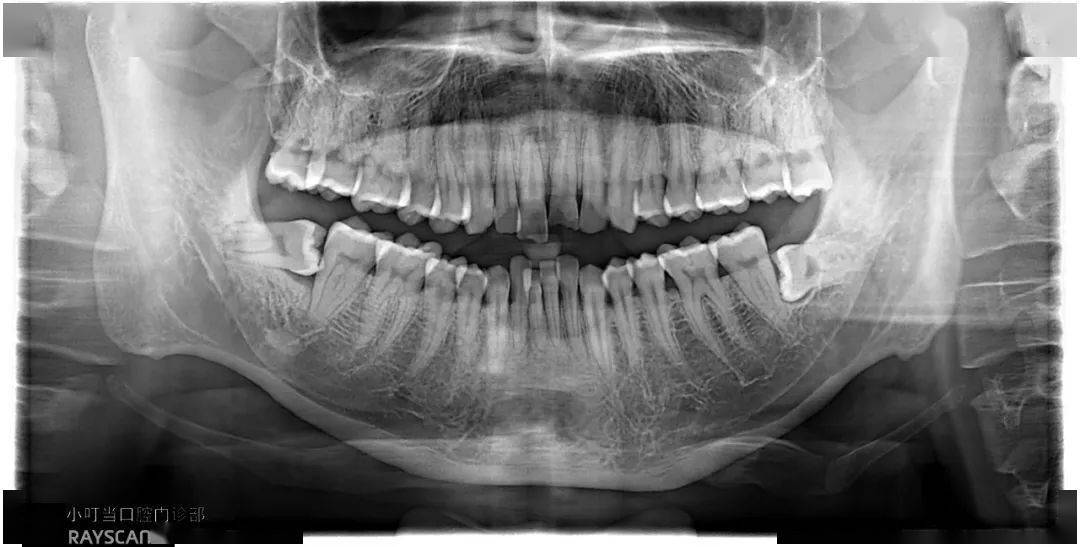 刘xx 20201003 智齿cbct 182xxxx2992