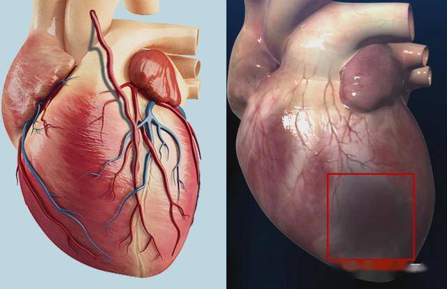 jama子刊再生医学技术治疗缺血性心脏病取得重要进展