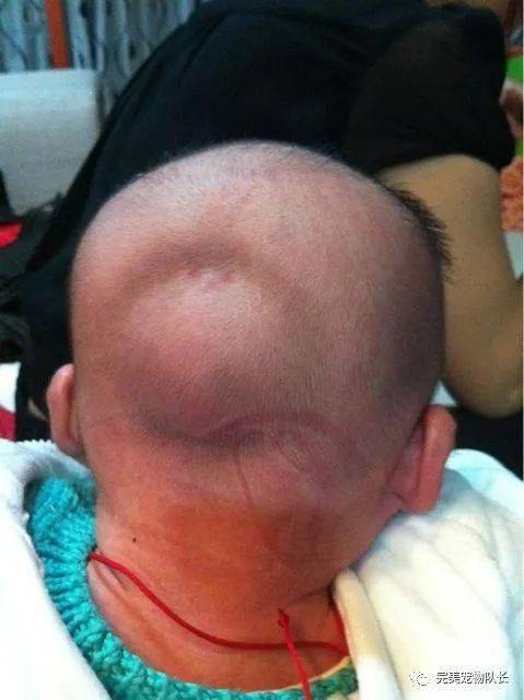 婴儿后脑勺有个凹陷图片