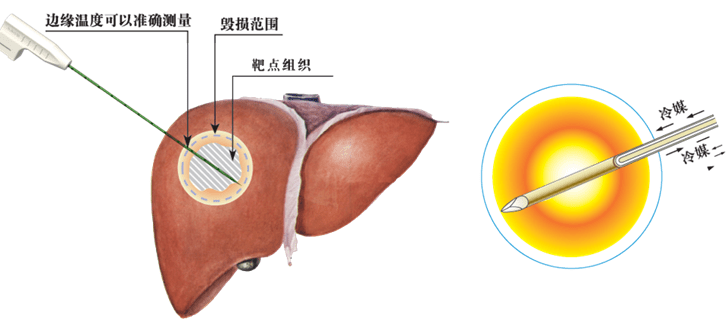 【科普】肿瘤微创治疗之五虎上将——微波消融_手机搜狐网