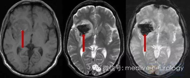 腦出血ct,mri之爭的終結者:gre序列(t2*&swi)_成像