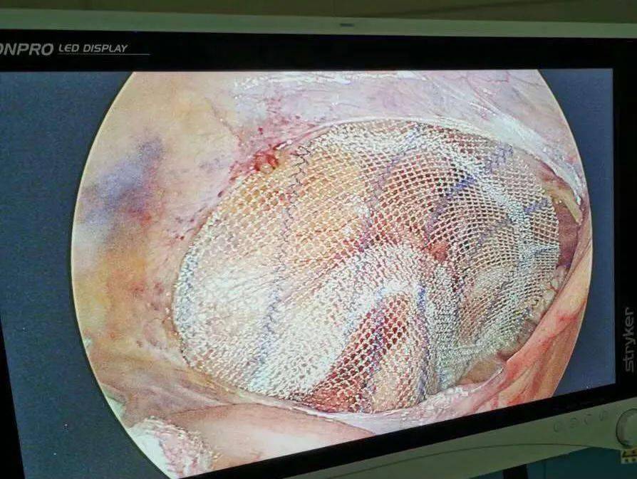 会理县中医医院成功开展一例腹股沟复发疝修补术!