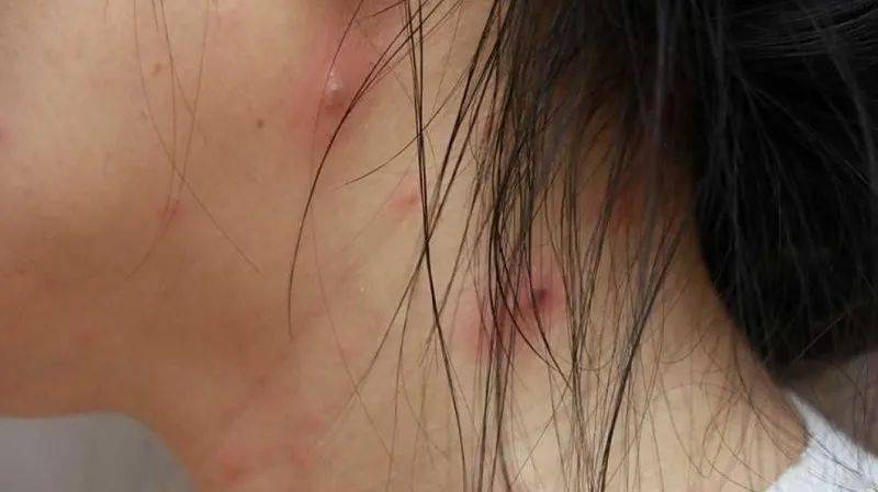 而感染水痘的幼儿要持续留意,有无继发性细菌感染,败血症或脑炎等并发