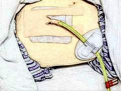呼吸机t管图片