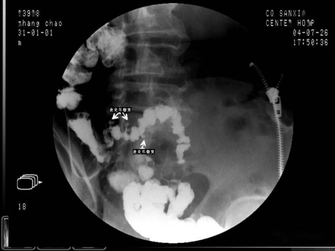 汇总消化道疾病影像诊断与鉴别
