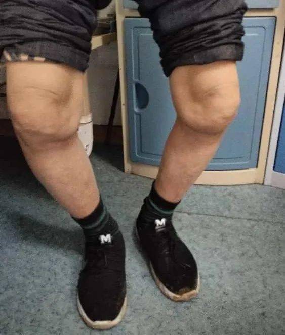 膝关节内翻畸形20年赵滨教授助他正常行走