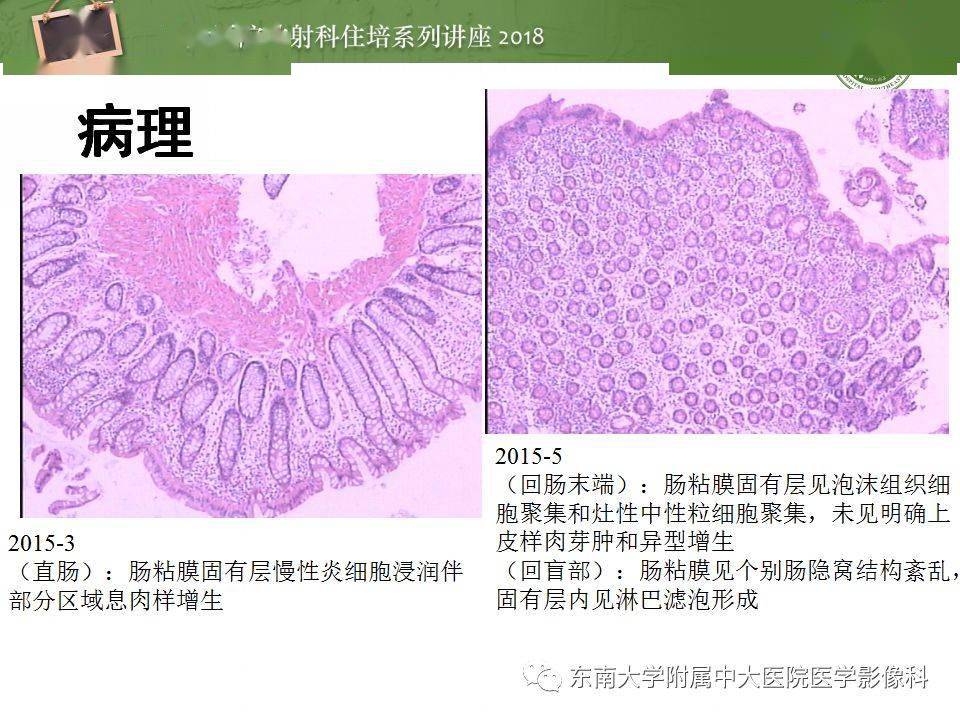 组织病理学:粘膜下固有层增厚伴慢性炎症细胞浸润,隐窝结构扭曲