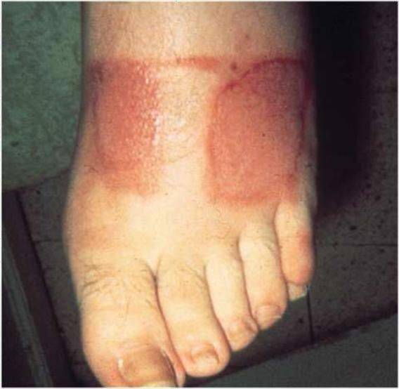 医用胶布都能粘出压疮看来你是不会怎么撕胶布