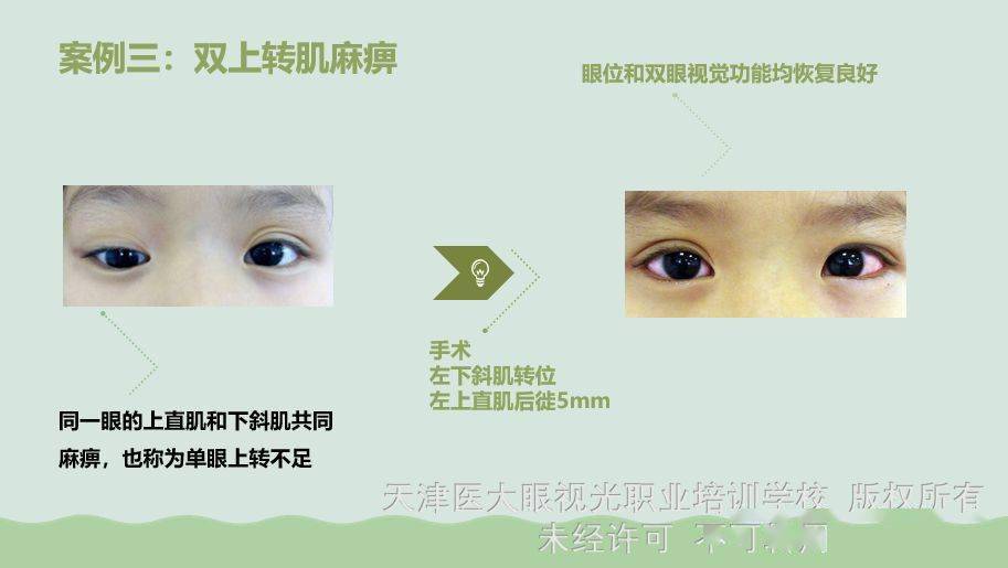 即同一眼的上直肌和下斜肌共同麻痹,也称为单眼上转不足.