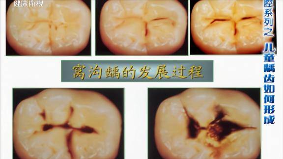 龋齿的发展过程这张图看的很直观到后期引起并发症对症下药