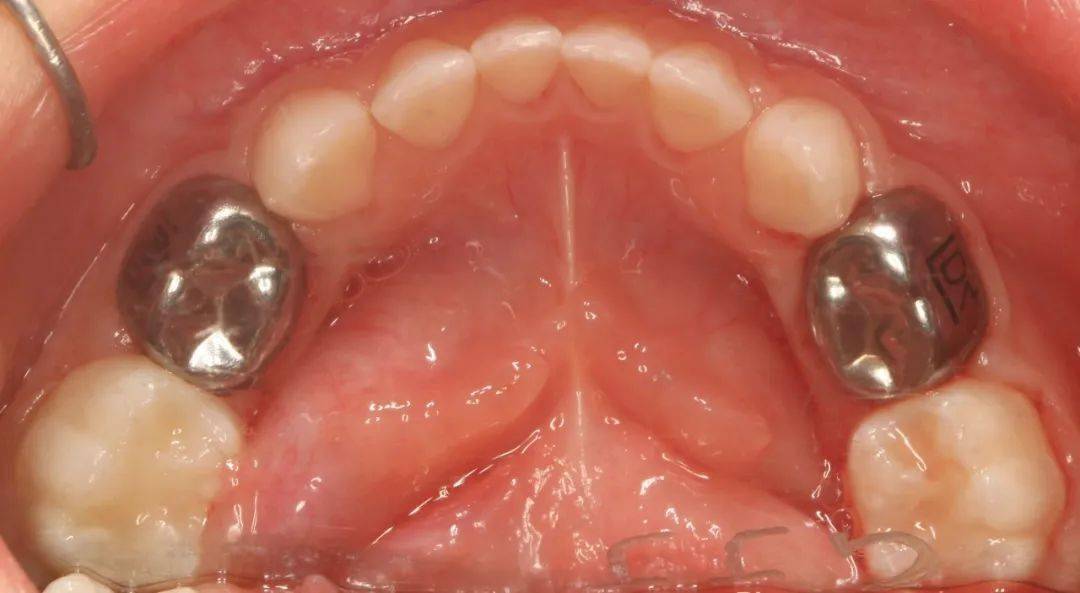 metal crown,pmc)是一个预先成型的,与牙齿非常贴合的不锈钢金属牙冠