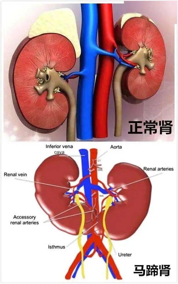 罕见马蹄肾里长了个「玉如意」,给大爷整懵了!
