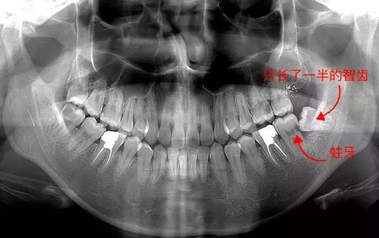 智齒該拔就得拔!不然可能丟了小命!_牙齒