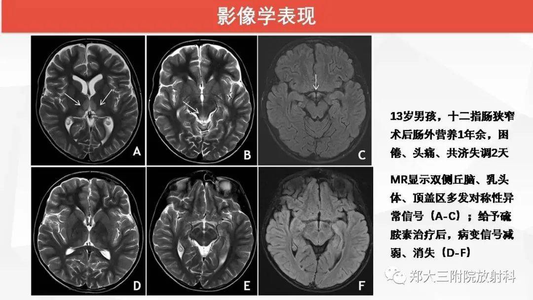 wernicke脑病的影像诊断
