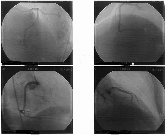 即使是小分支冠脉导致的心肌缺血也可以显示出来,而且它是无创性的