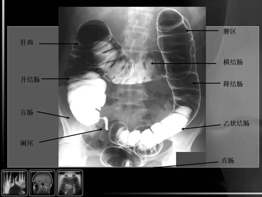 消化道疾病影像诊断与鉴别_造影