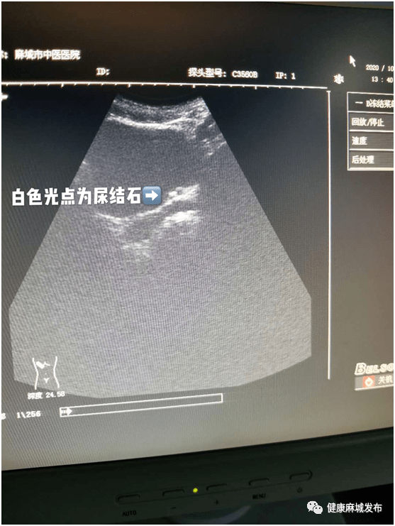 石石牵挂碎碎平安麻城市中医医院开展多例体外冲击波碎石术