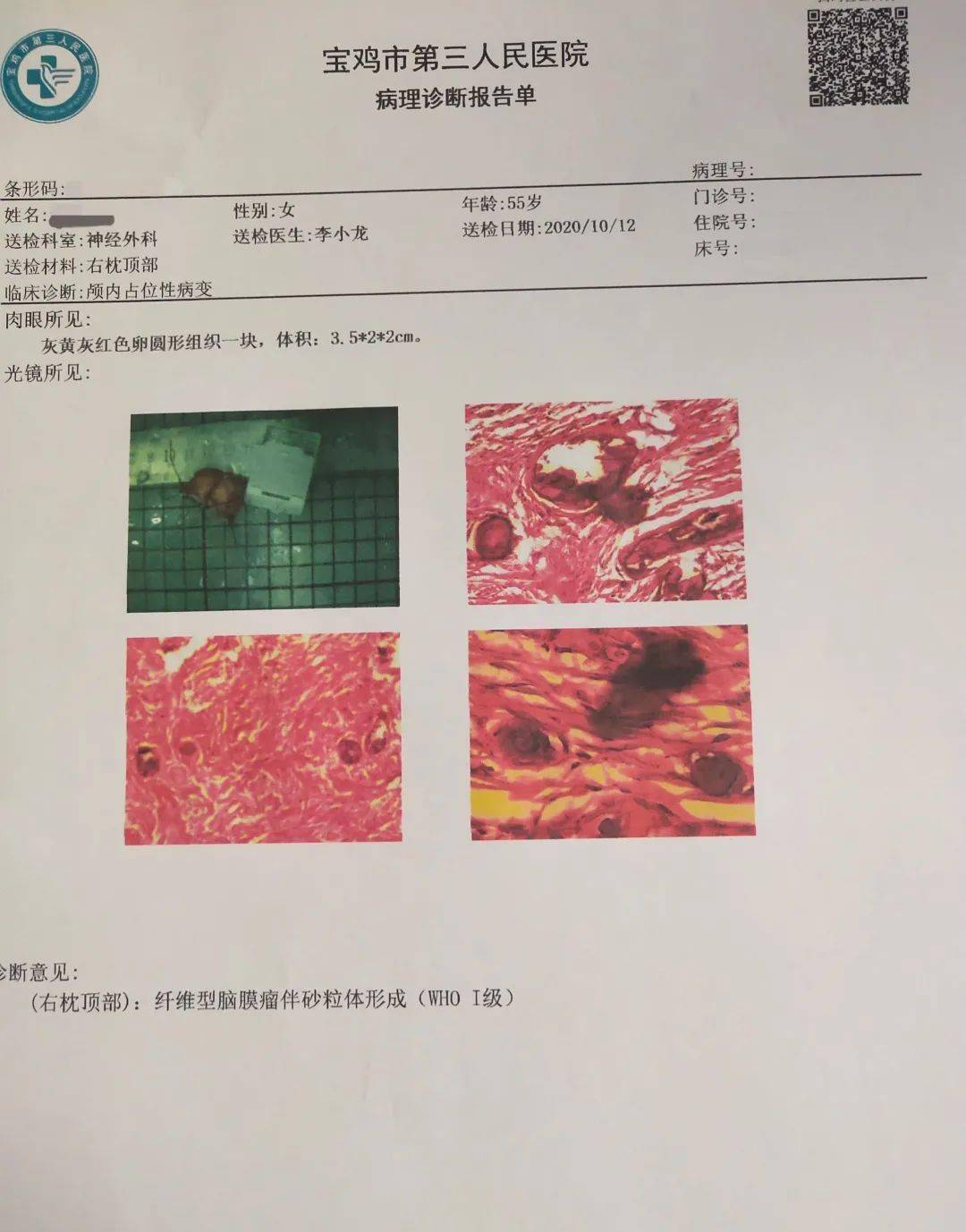 脑肿瘤诊断报告图片图片