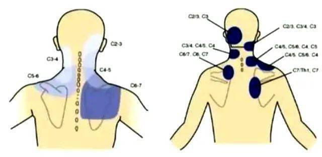 7種引起頸部和上肢神經疼痛的疾病你知道多少