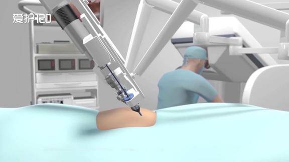 医生是如何操作机器人进行子宫切除手术的3d动画演示全过程