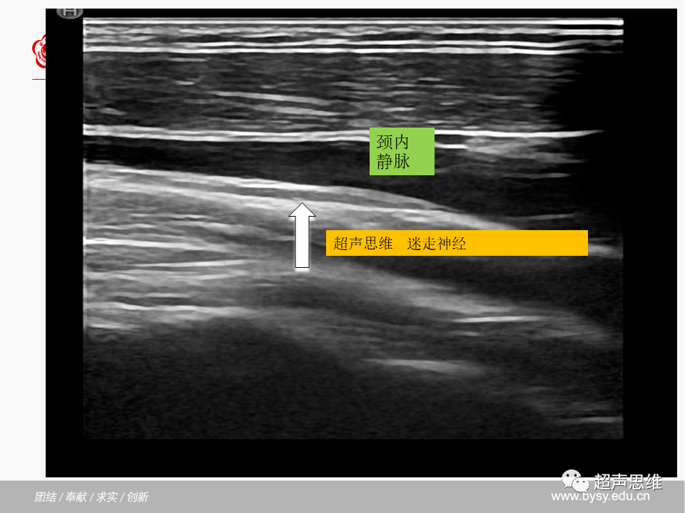 甲状旁腺超声声像图图片