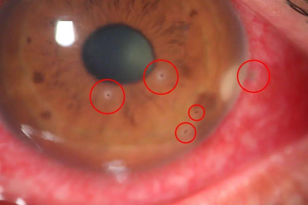 恐怖!连州一村民上山摘板栗,结果进了医院……大家小心这种"暗器"