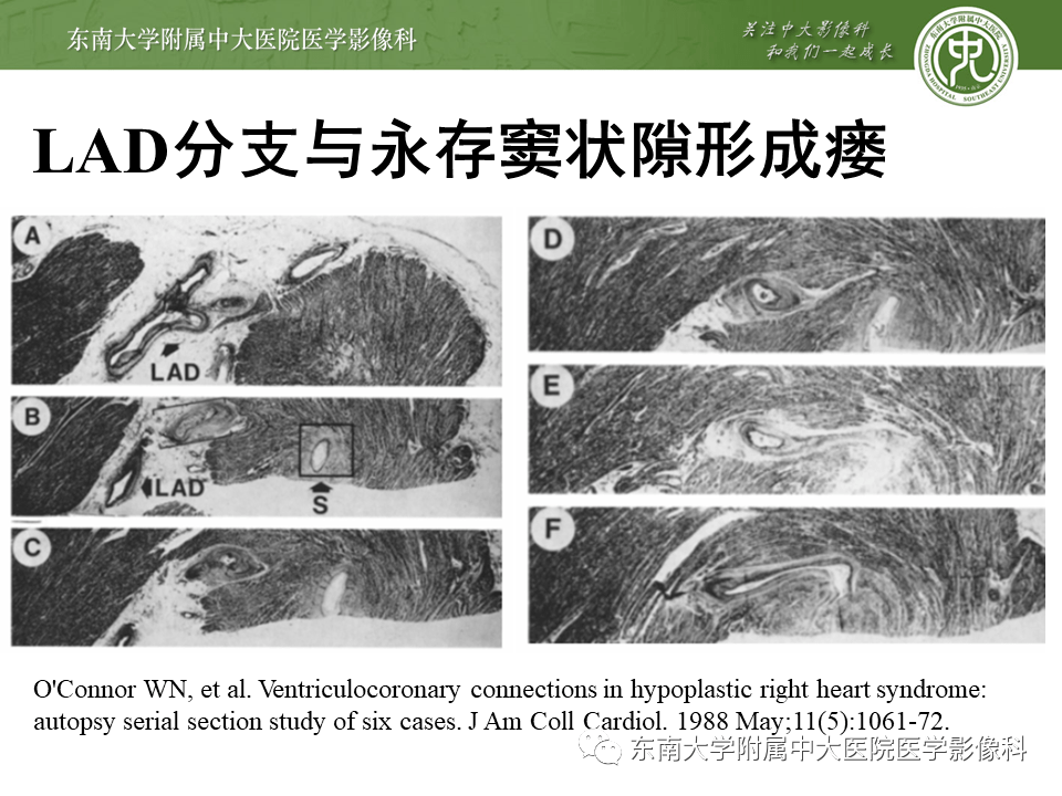 晨讀結果公佈20201026循環系統疾病心肌緻密化不全