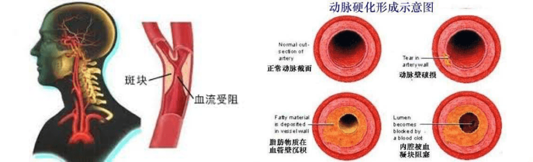 金医健康卒中日话卒中2都是颈动脉狭窄惹的祸