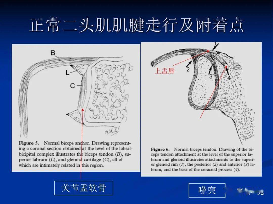 肩袖解剖及損傷的臨床及mri診斷