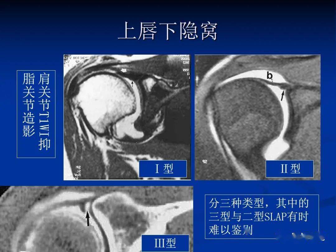 肩袖解剖及损伤的临床及mri诊断