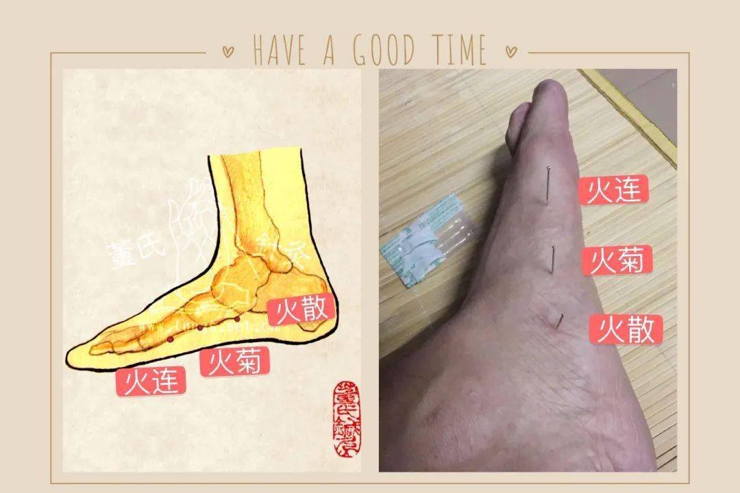 足三火:降血压,颅压,眼压木斗木留:专治抖不停,留不动三重:重症必用三