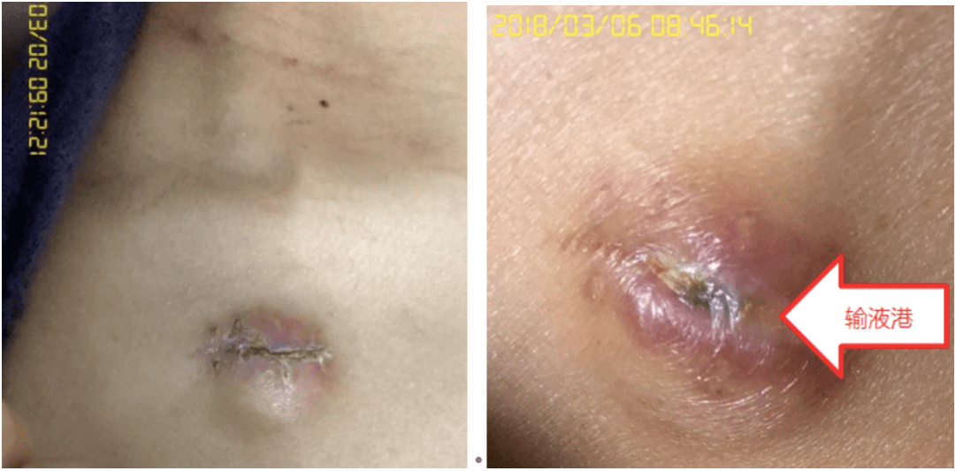 输液港植入术后一个月患者的切口还是没有愈合