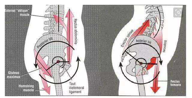 骨盆前倾与骨盆后倾该如何来调整