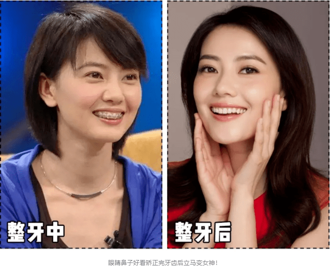 我花了5万块戴了2年牙套现在超后悔