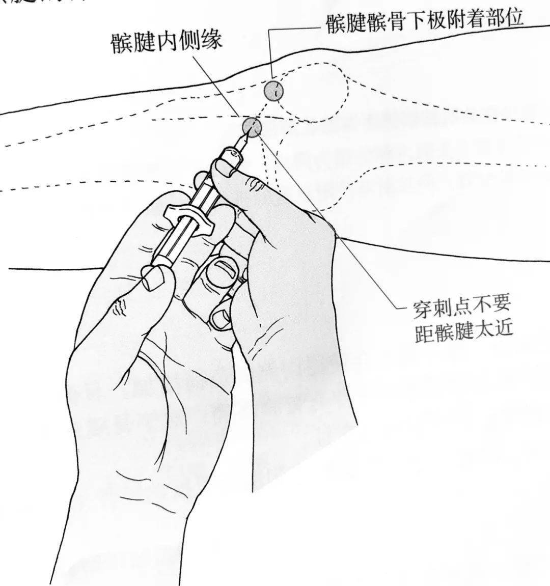 腕关节穿刺部位图解图片