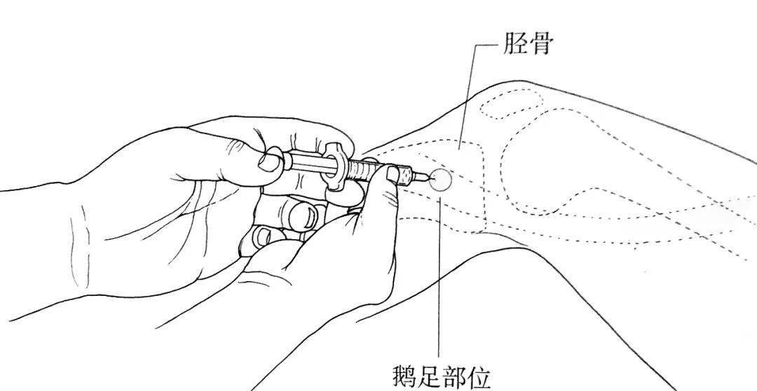 膝关节腔注射图解图片