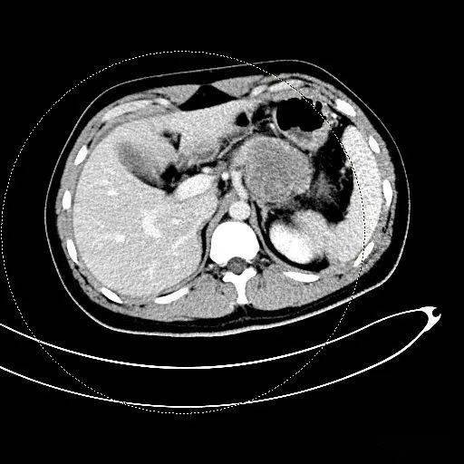 胰腺腺泡细胞癌